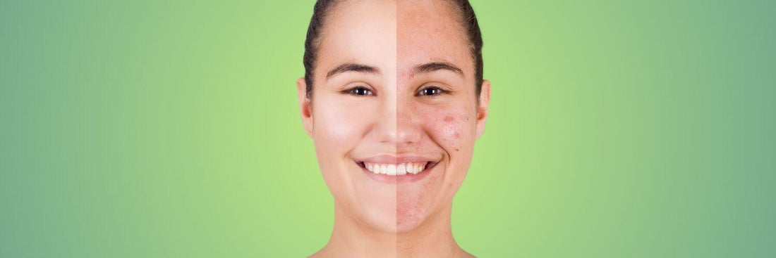 Decoding Period Acne: Expert Tips for Clearer Skin Before and During Your Cycle